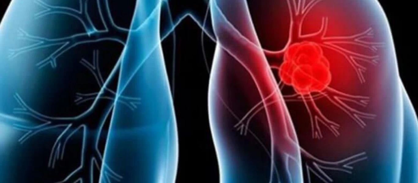 Καρκίνος του πνεύμονα: Ζωτικής σημασίας η έγκαιρη διάγνωση του